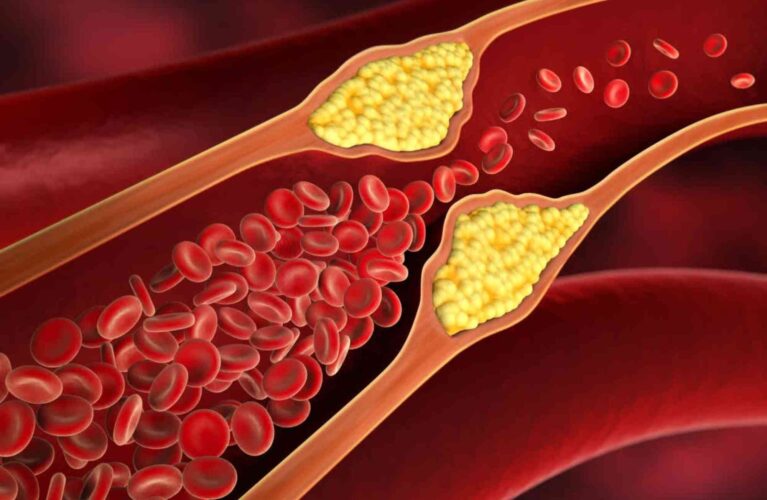 هل الكوليسترول المرتفع يسبب أمراض القلب؟